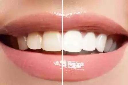 teeth whitening dental australia