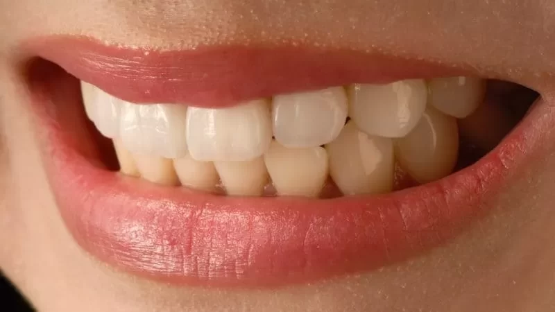 What problems can Porcelain Veneers fix?