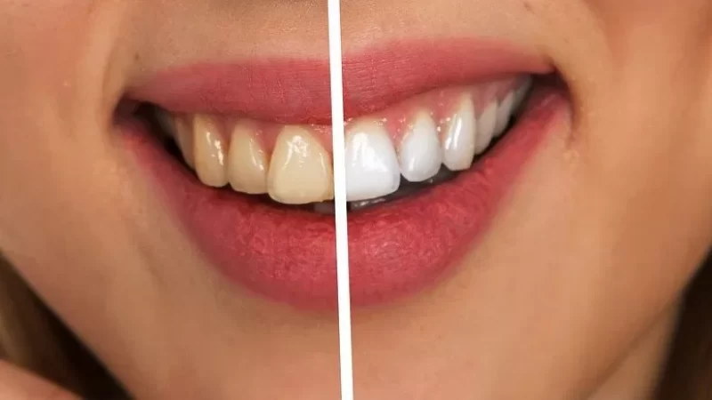 Is Teeth Whitening Safe? Exploring the Options